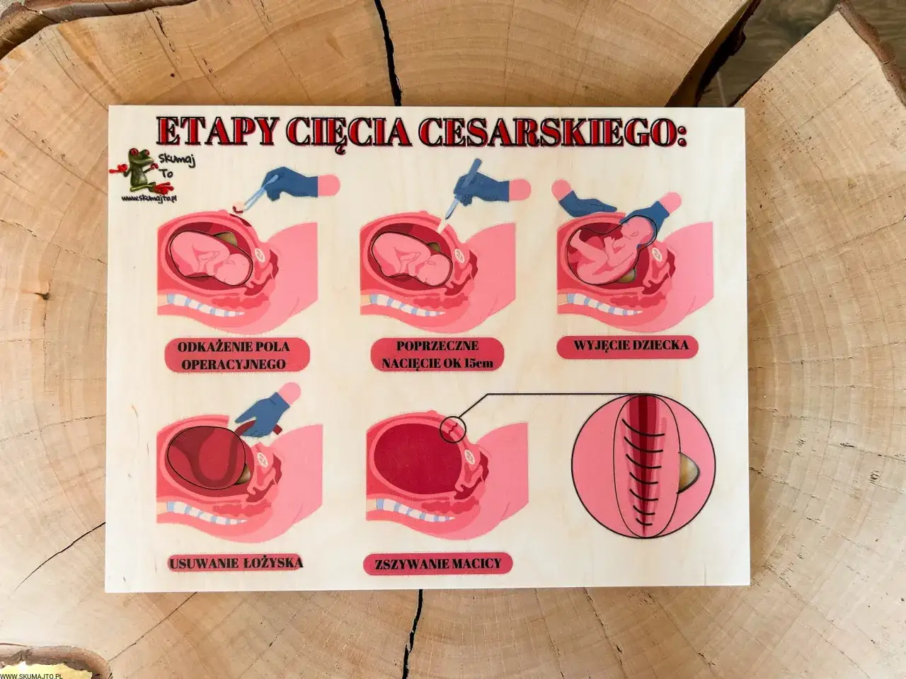 Ilustracja pokazuje etapy cesarskiego cięcia: odkażenie, nacięcie, wyjęcie dziecka, usunięcie łożyska i szycie. Dowiadujemy się, jak cesarka ile trwa.