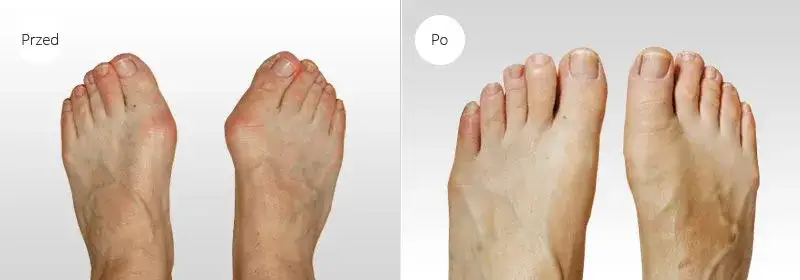 Etapy gojenia stopy po operacji haluksa infografika