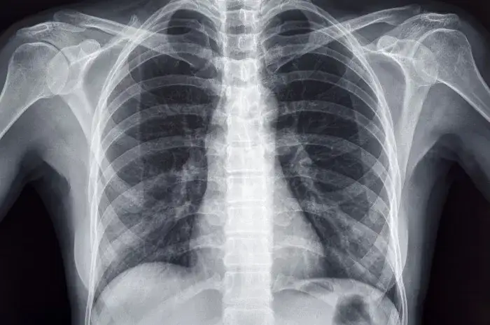 zdjęcie rentgenowskie klisza, skierowanie lekarskie