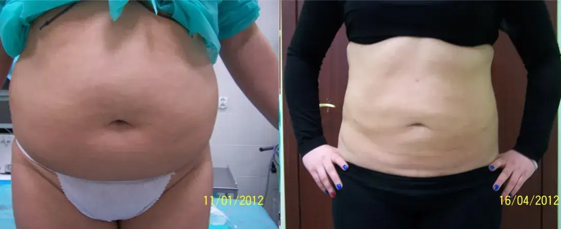 r&oacute;żne metody liposukcji brzucha por&oacute;wnanie