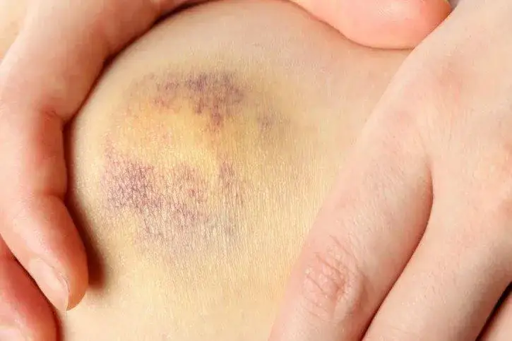 skręcone kolano opuchlizna krwiak