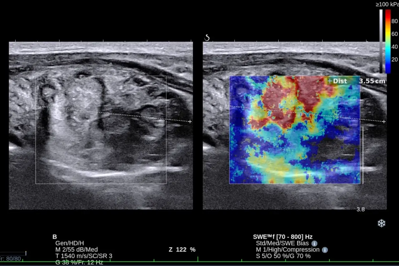 Obraz USG tarczycy z kolorową mapą elastograficzną. Wymiary tarczycy usg norma jest widoczna na skali.