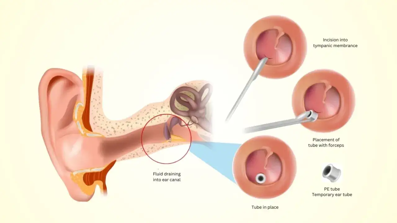Ilustracja przedstawia zabieg drenażu uszu: nacięcie błony bębenkowej, umieszczenie drenu i jego działanie.