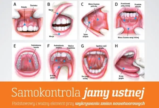 diagnostyka nowotworu jamy ustnej