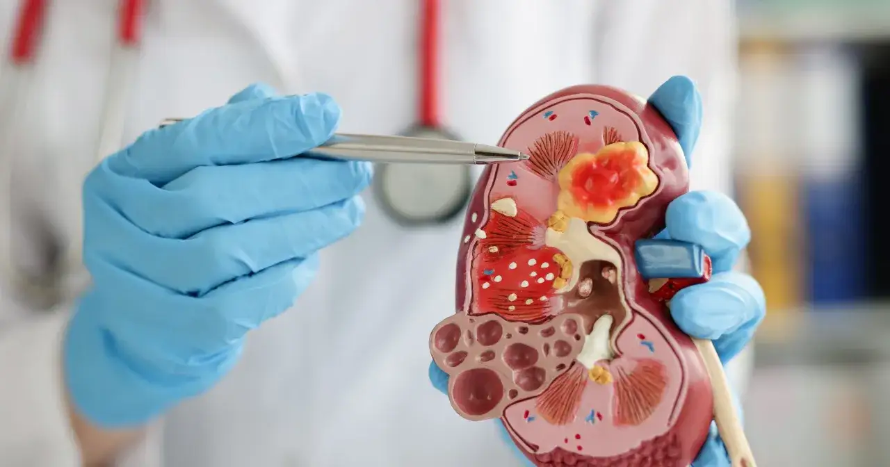 Lekarz w niebieskich rękawiczkach pokazuje model nerki z widocznymi zmianami, które mogą być związane z podwyższoną kreatyniną we krwi objawy.