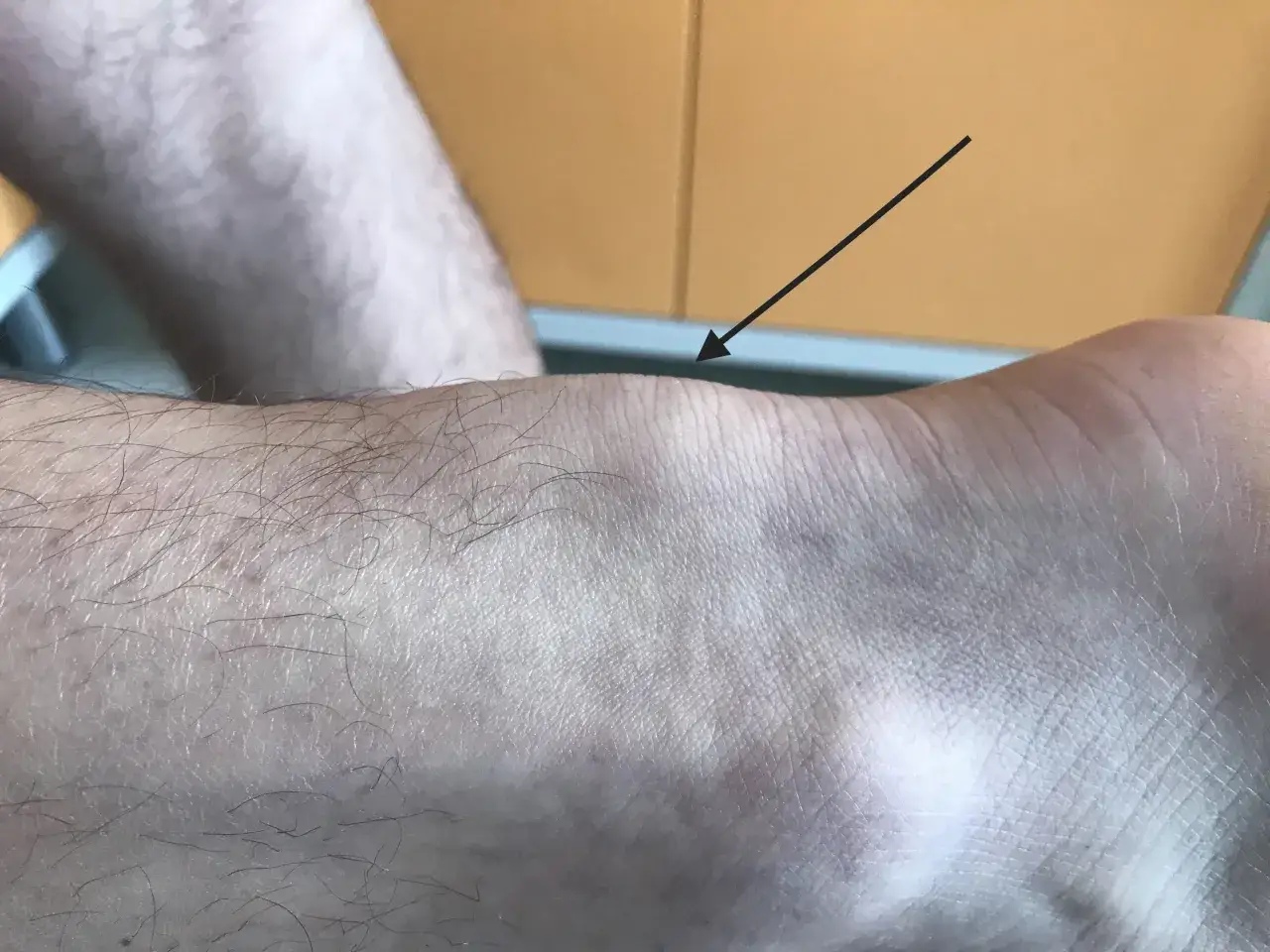 kontuzje biegacza achilles śródstopie