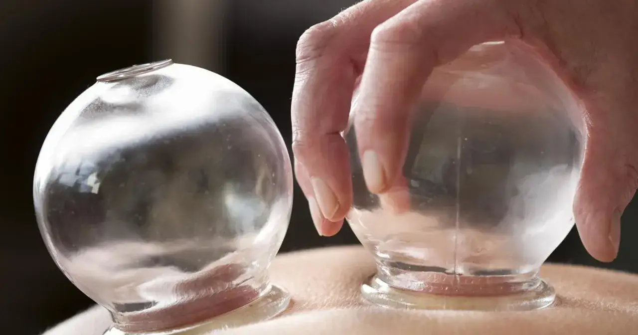 Dłoń umieszcza szklane bańki na plecach. Stawia się je, by wspomóc krążenie i złagodzić ból.