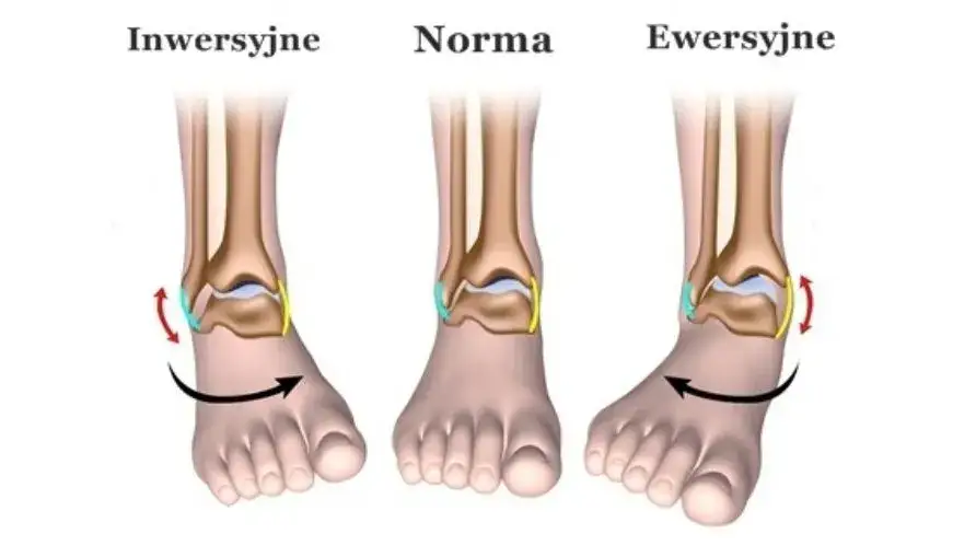 stopnie skręcenia stawu skokowego ilustracja
