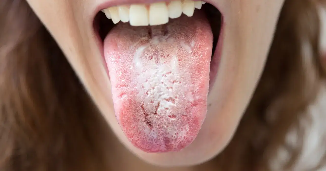 Język pokryty białym nalotem, może wskazywać na pieczenie języka przyczyny, np. infekcję grzybiczą.