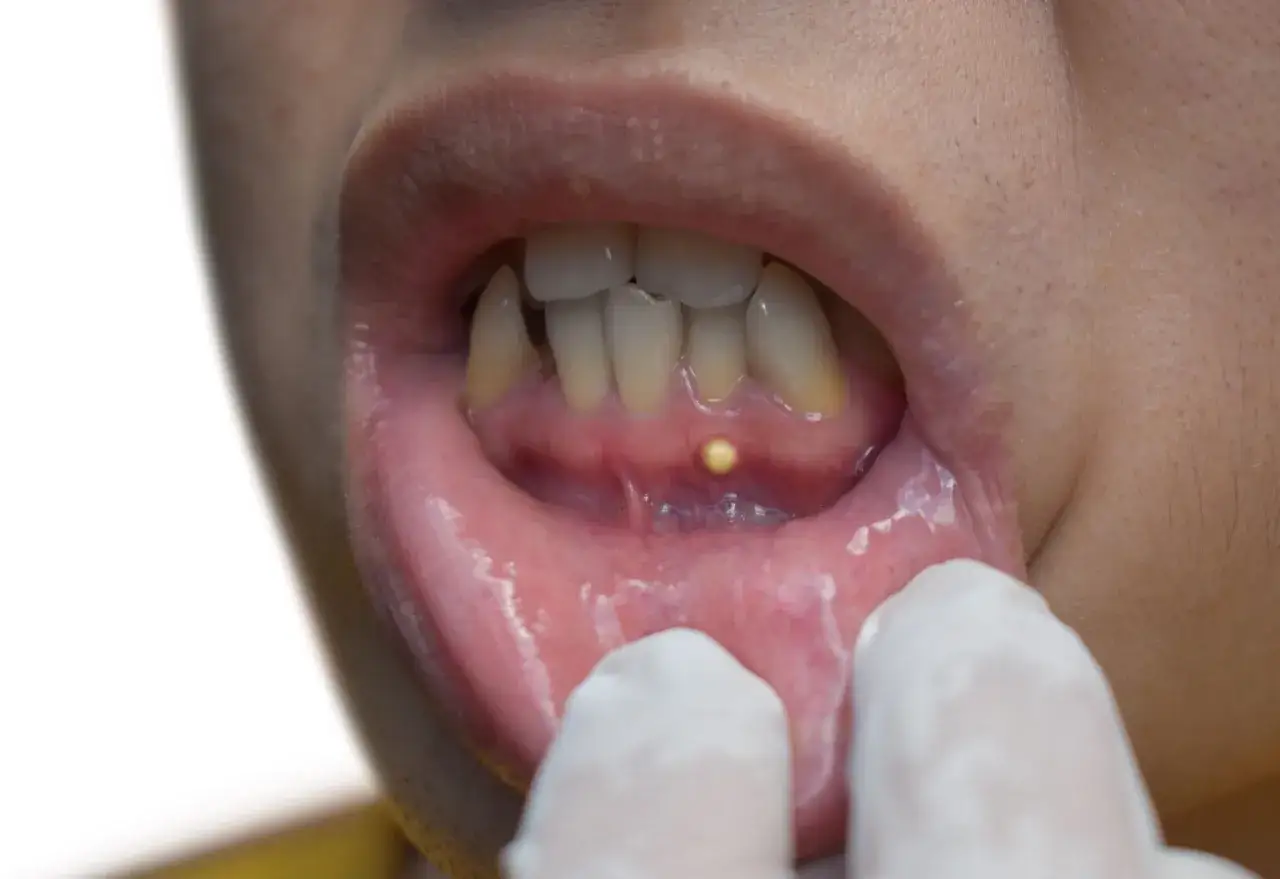 Widoczne małe, żółte skupisko ropy na dziąśle, wskazujące na ropień okołowierzchołkowy.