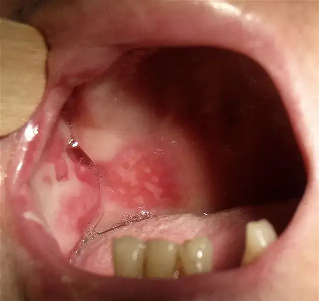 Zdjęcie Objawy ropowicy dna jamy ustnej: jak rozpoznać i uniknąć poważnych powikłań