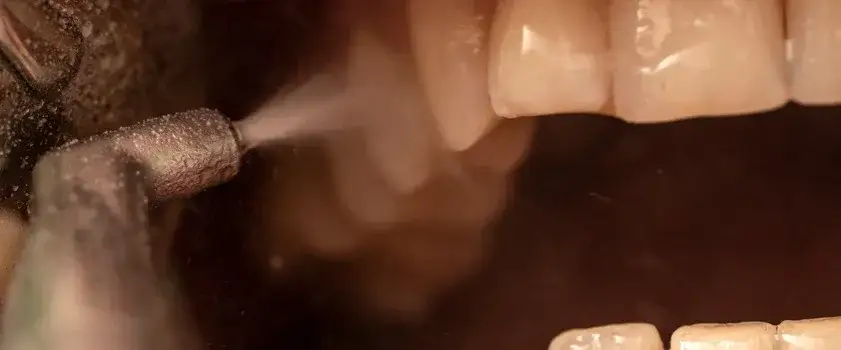 Zdjęcie Piaskowanie zębów co to? Poznaj korzyści i przebieg zabiegu