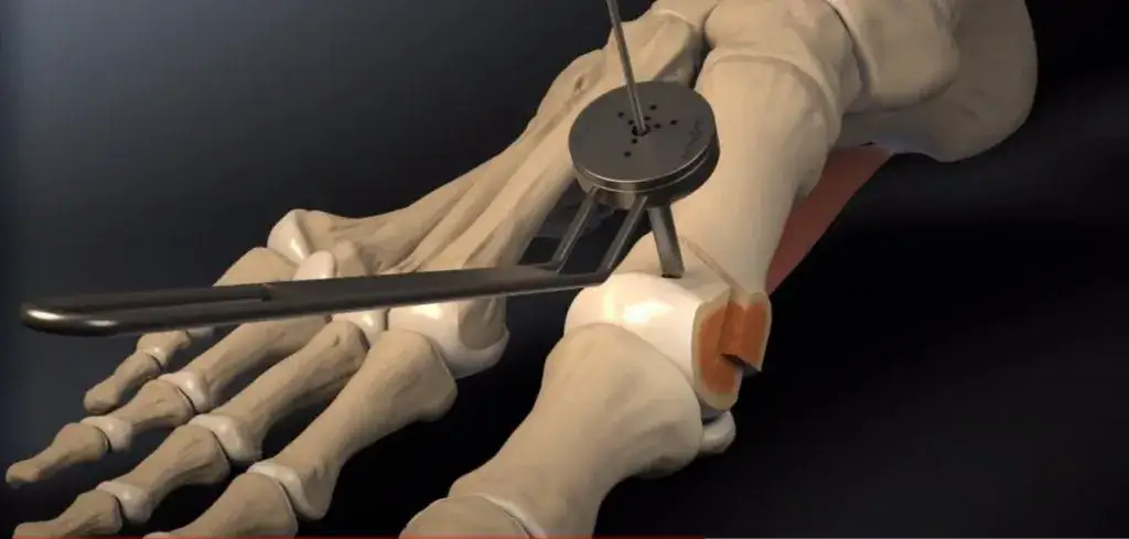 Nowoczesne techniki operacji haluksów