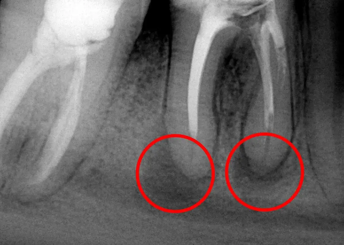RTG zęba z widocznymi zmianami okołowierzchołkowymi, sugerującymi torbiel pod zębem powikłania.
