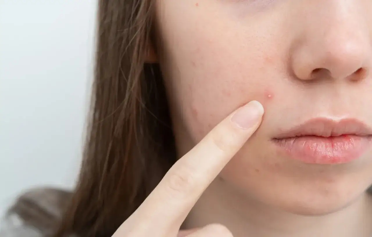 domowe sposoby na pryszcze punktowo