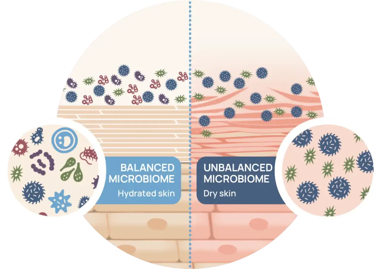Ilustracja pokazuje, co to jest mikrobiom: zr&oacute;wnoważony mikrobiom sk&oacute;ry nawilżonej i niezr&oacute;wnoważony mikrobiom sk&oacute;ry suchej.