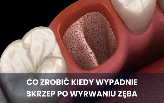 zimne okłady po ekstrakcji zęba