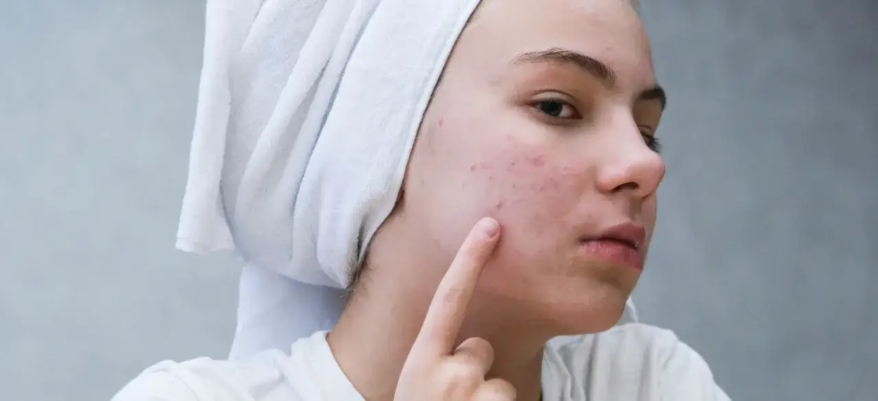 Zdjęcie Jak pozbyć się bolącego pryszcza skutecznie i bez ryzyka blizn