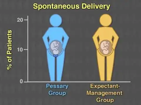 Zdjęcie Kiedy poród po zdjęciu pessara? Wszystko, co musisz wiedzieć o pessarze i terminie porodu