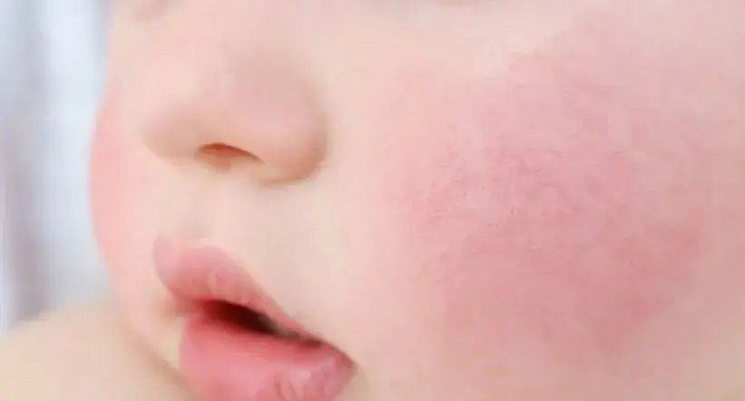 Zdjęcie Objawy alergii u niemowlaka: co każda mama karmiąca piersią powinna wiedzieć