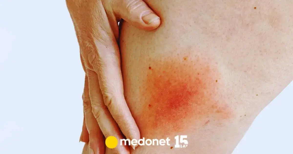 Zdjęcie Kleszcz w uchu człowieka objawy - co musisz wiedzieć, aby nie ryzykować