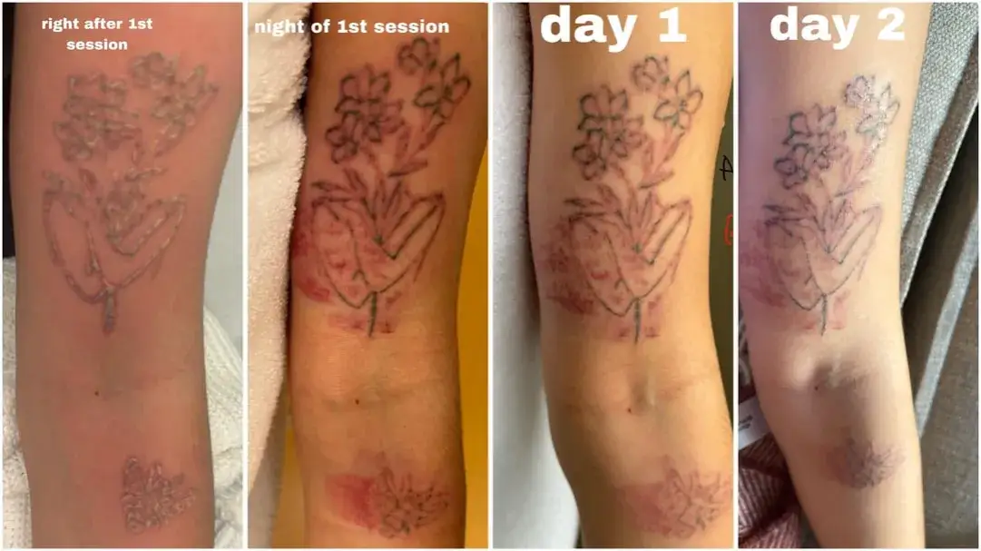 Zdjęcie Co dzieje się ze skórą podczas gojenia tatuażu? Poznajemy te etapy