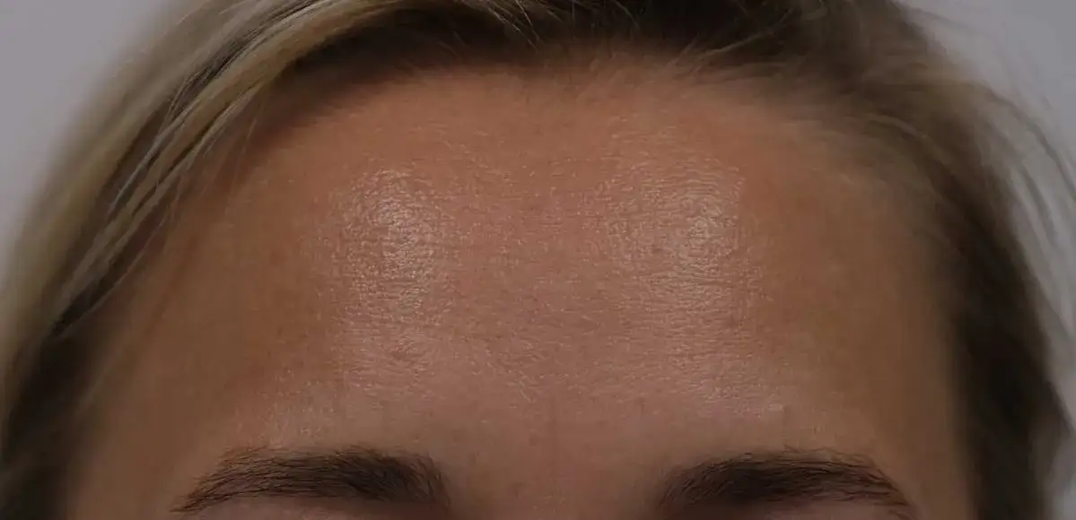 Zdjęcie Alternatywy dla botoksu na czoło: skuteczne zabiegi bez igły