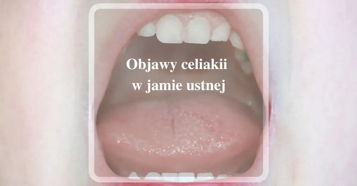 Zdjęcie Jak sprawdzić uczulenie na gluten i uniknąć nieprzyjemnych objaw&oacute;w