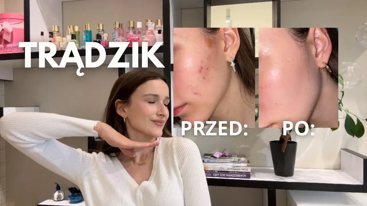 Zdjęcie Jak wyleczyć pryszcza skutecznie i szybko – sprawdzone metody na trądzik