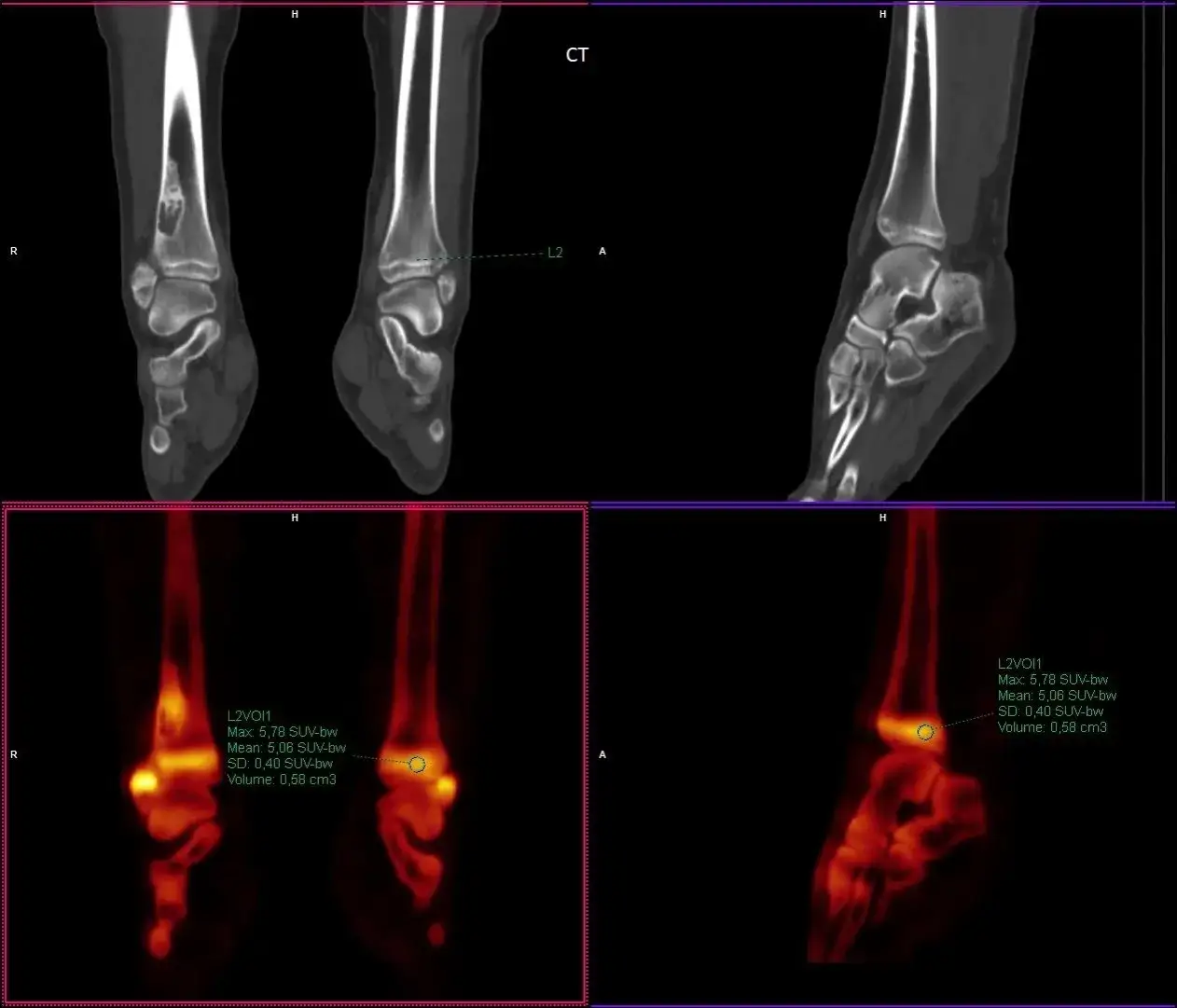 Zdjęcie Co oznacza SUV w badaniu PET i jak wpływa na diagnozę nowotworów?