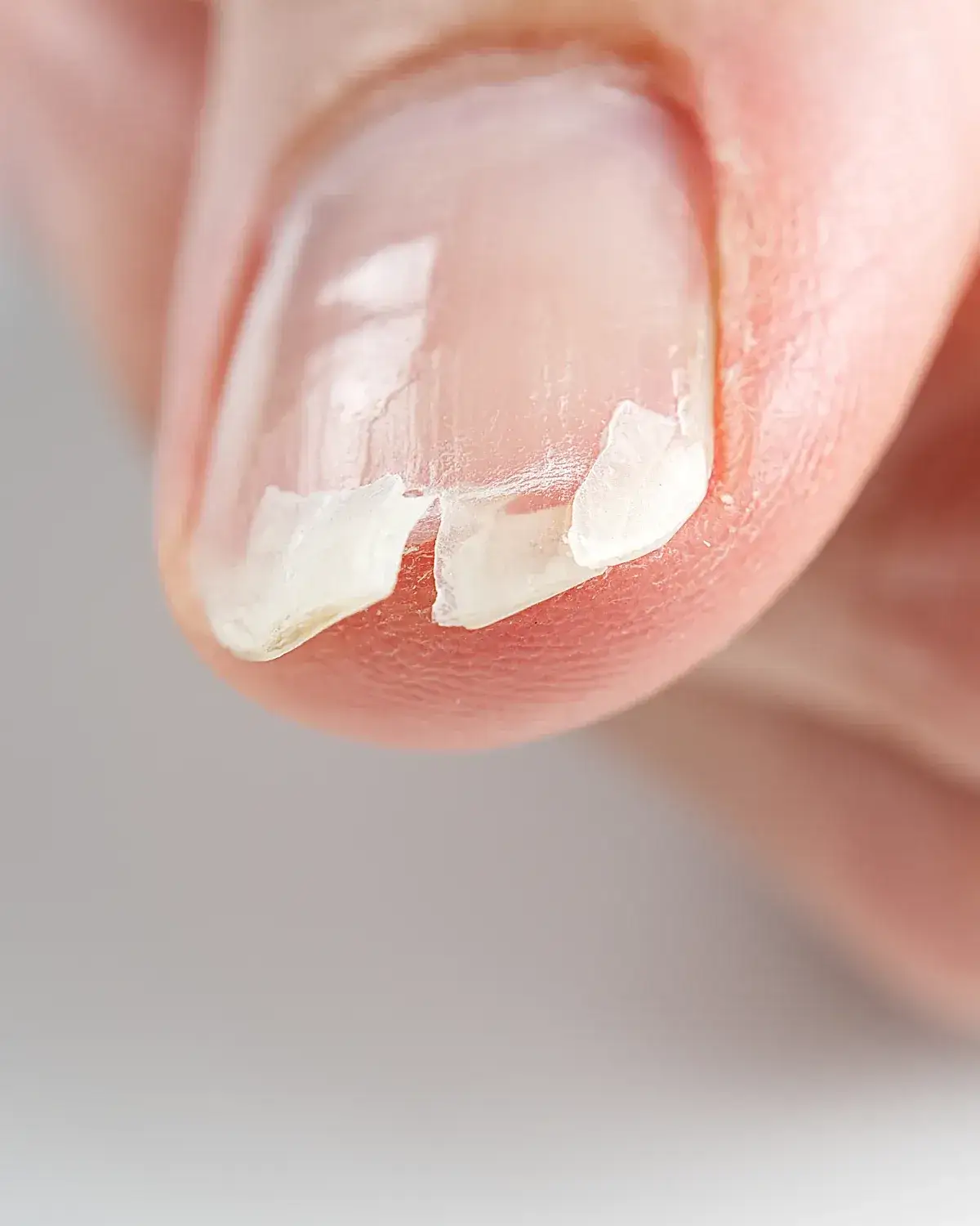 Zdjęcie Co zrobić jak zejdzie paznokieć - skuteczne metody na ból i infekcję