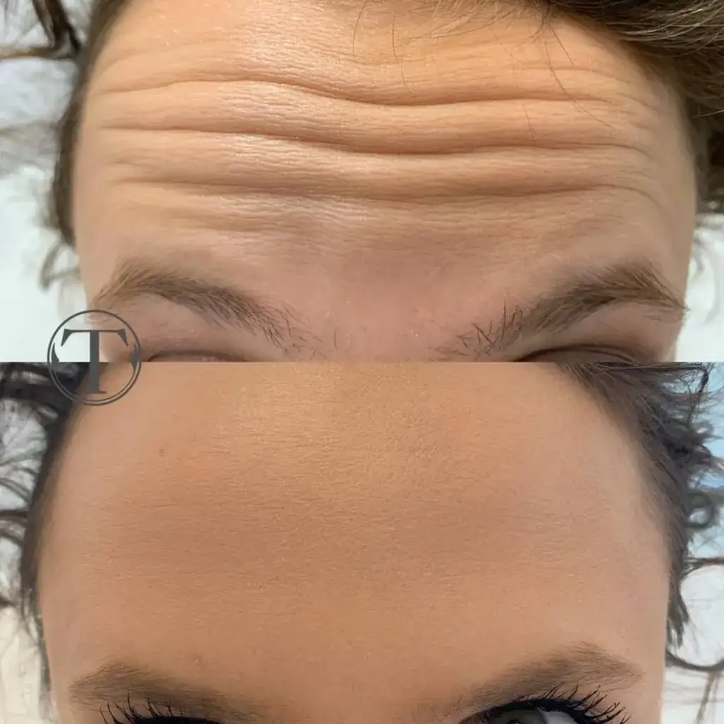 Zdjęcie Ile kosztuje botoks na kurze łapki? Ceny w Polsce i co wpływa na nie