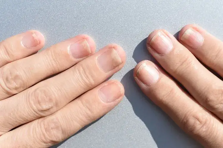 Zdjęcie Jak skutecznie leczyć onycholizę po hybrydzie i uniknąć bólu