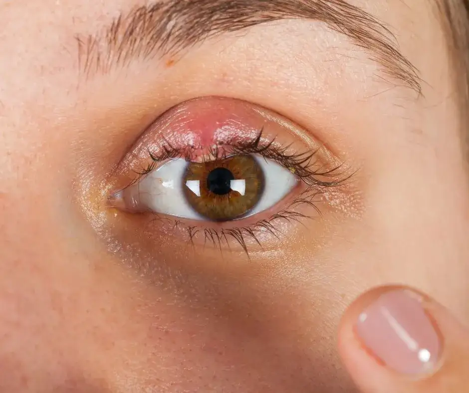 Zdjęcie Czy dziecko z jęczmieniem może iść do przedszkola? Sprawdź objawy