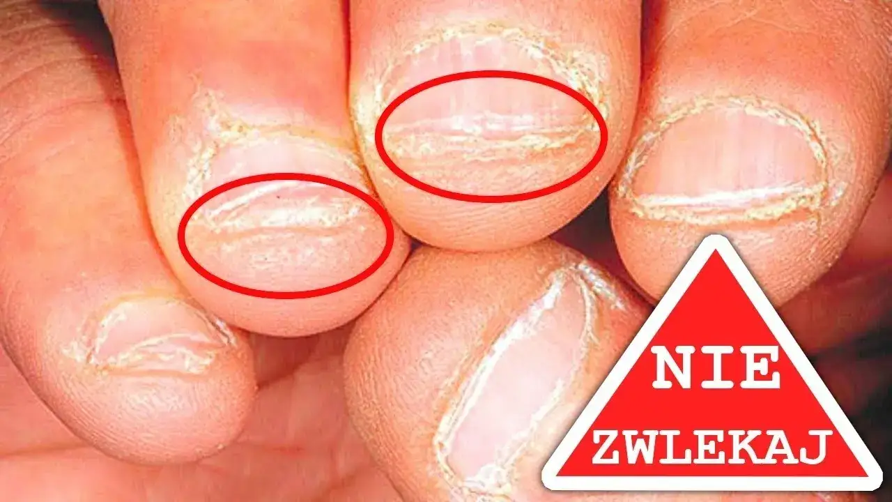 Zdjęcie Jak oduczyć się obgryzać paznokcie i odzyskać zdrowe dłonie