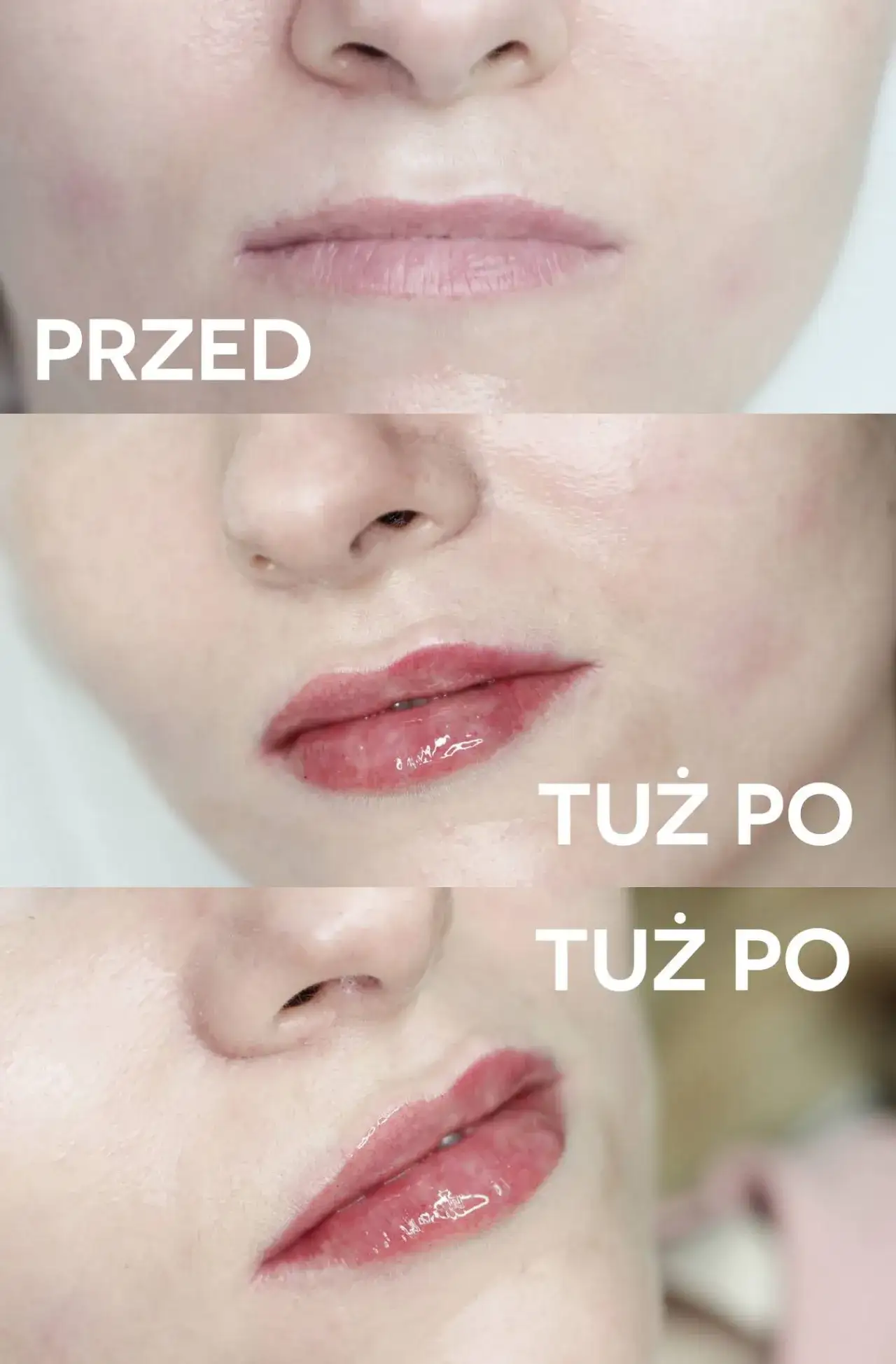 Zdjęcie Ile kwasu hialuronowego w usta? Odkryj idealną dawkę dla siebie