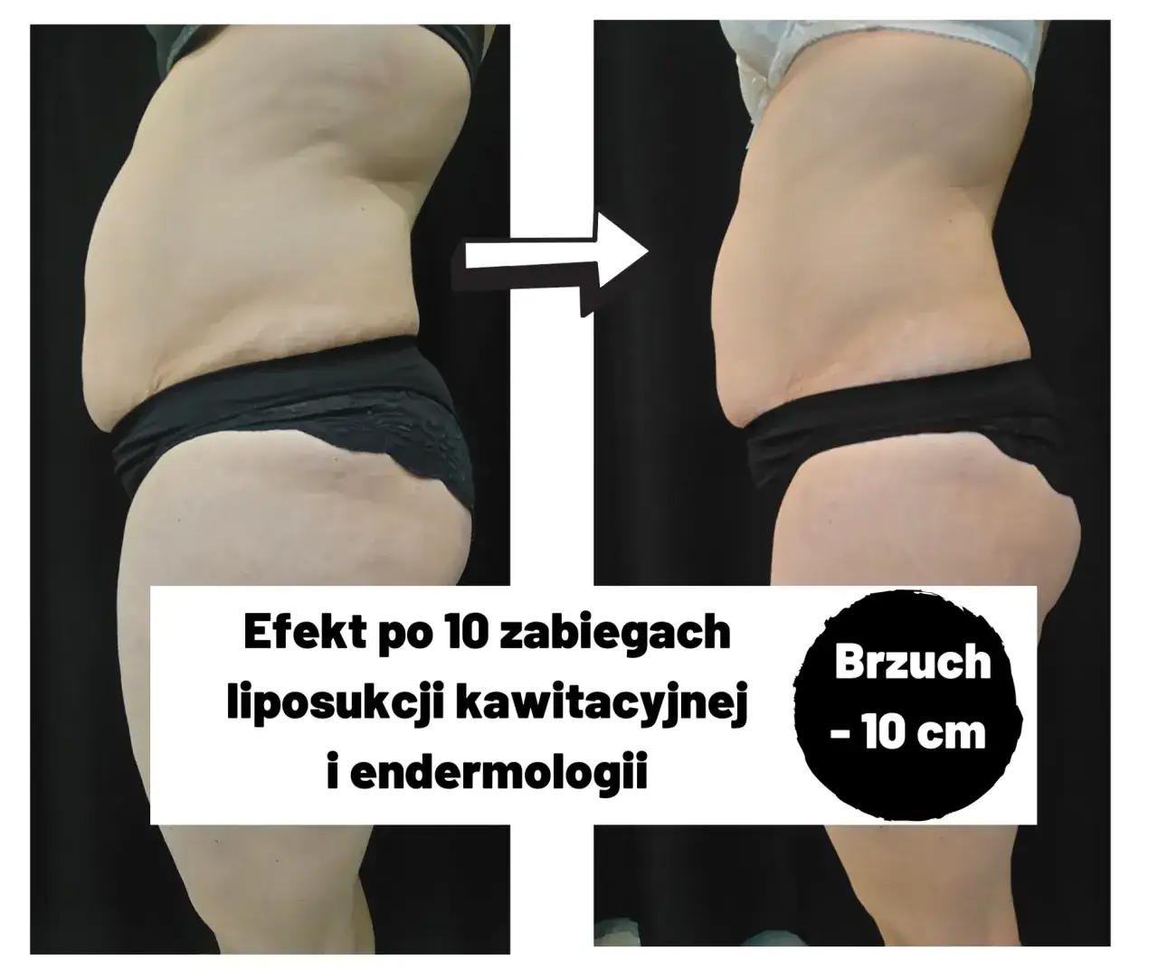 Zdjęcie Endermologia hit czy kit - prawda o skuteczności zabiegu
