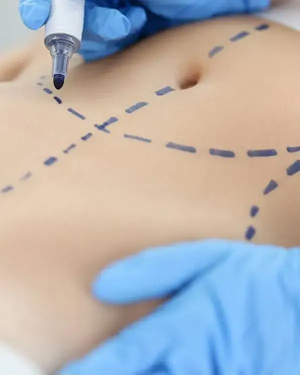 Zdjęcie Jaka liposukcja jest najlepsza? Poznaj skuteczne metody i ich efekty