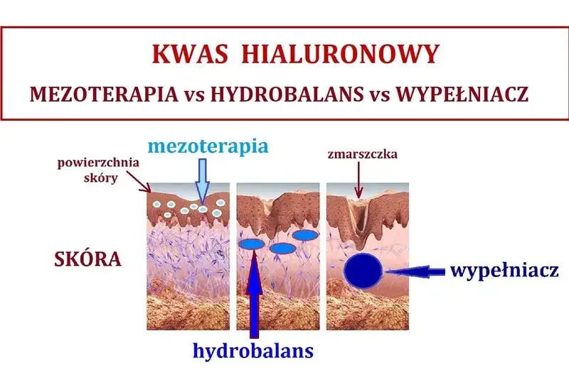 Zdjęcie Jak głęboko wstrzykuje się kwas hialuronowy? Poznaj kluczowe informacje