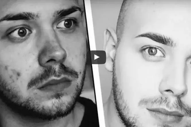 Zdjęcie Jak ukryć pryszcze bez makijażu? Skuteczne metody i porady