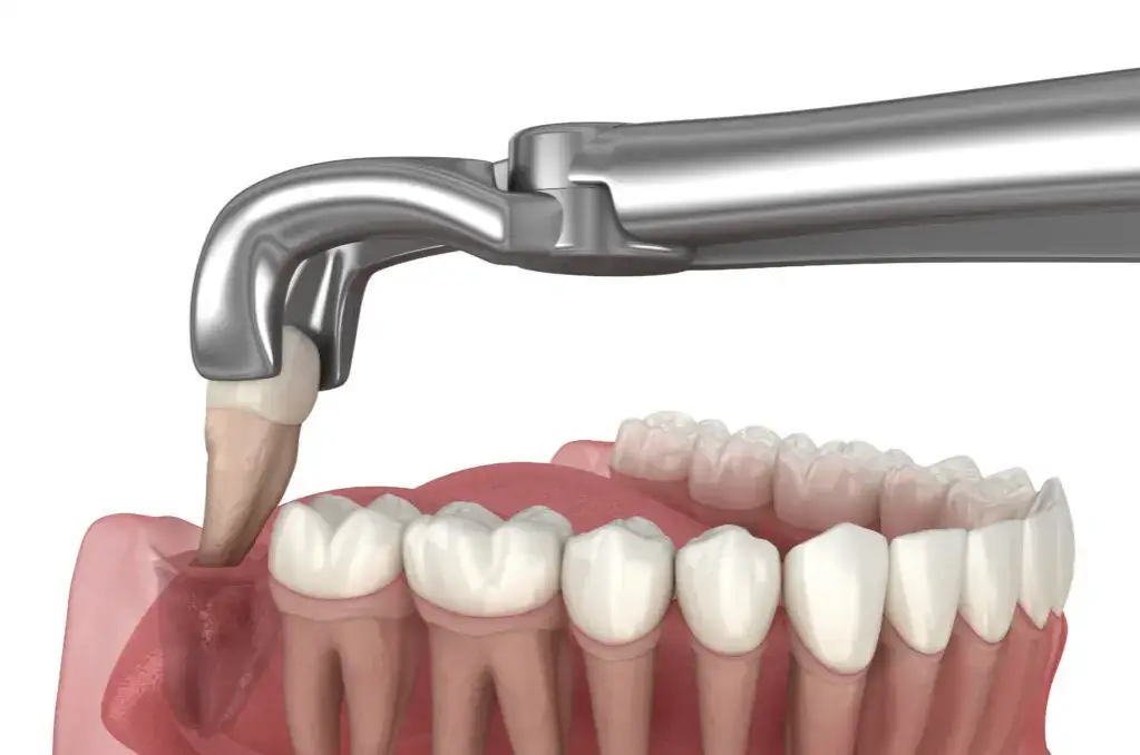 Zdjęcie Ból kości po ekstrakcji zęba: Jak długo trwa i kiedy do dentysty?