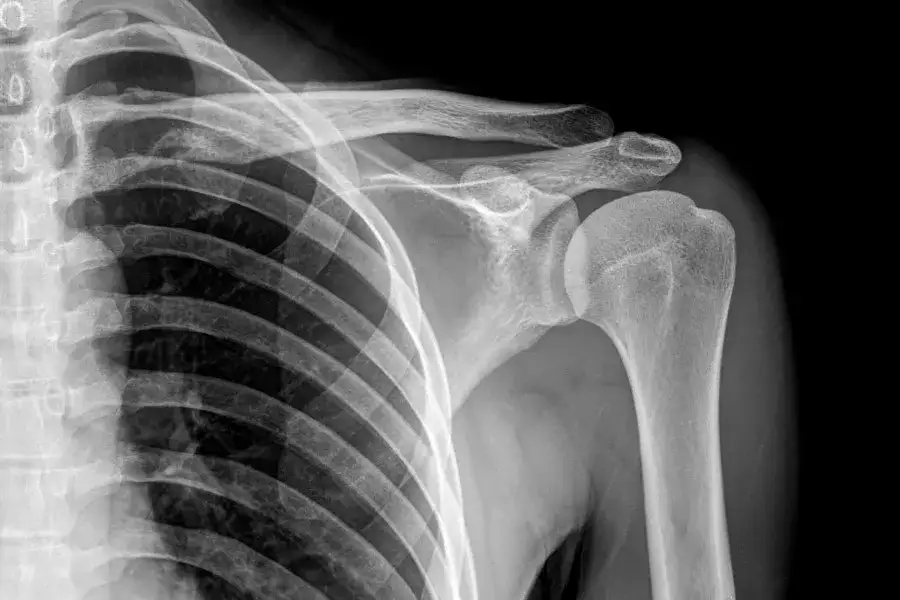 Zdjęcie Sklerotyzacja stropu panewki: przyczyny, objawy i skuteczne leczenie