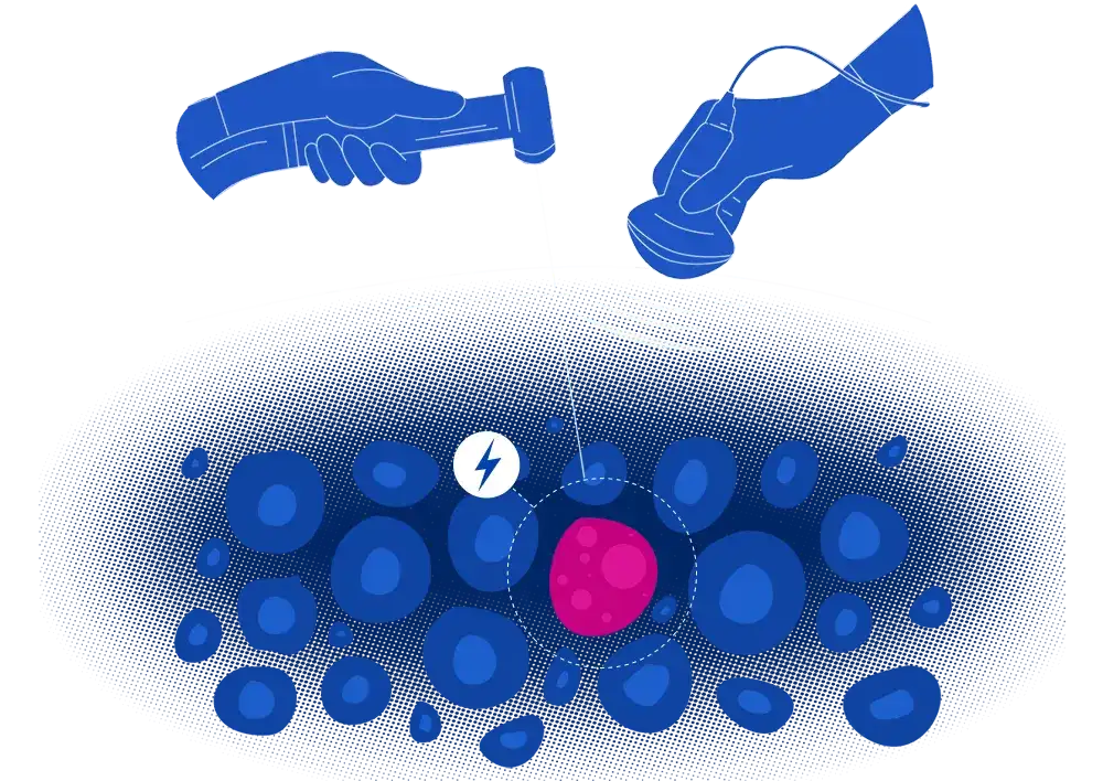 Zdjęcie Czy termoablacja jest refundowana przez NFZ? Sprawdź, co musisz wiedzieć
