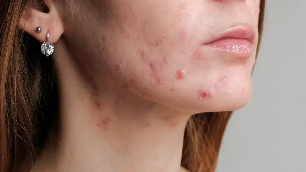 Zdjęcie Ile dni przed okresem wyskakują pryszcze i jak ich uniknąć?