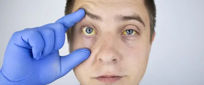 Zdjęcie Skuteczne leczenie podwyższonego poziomu bilirubiny: metody i wskazówki