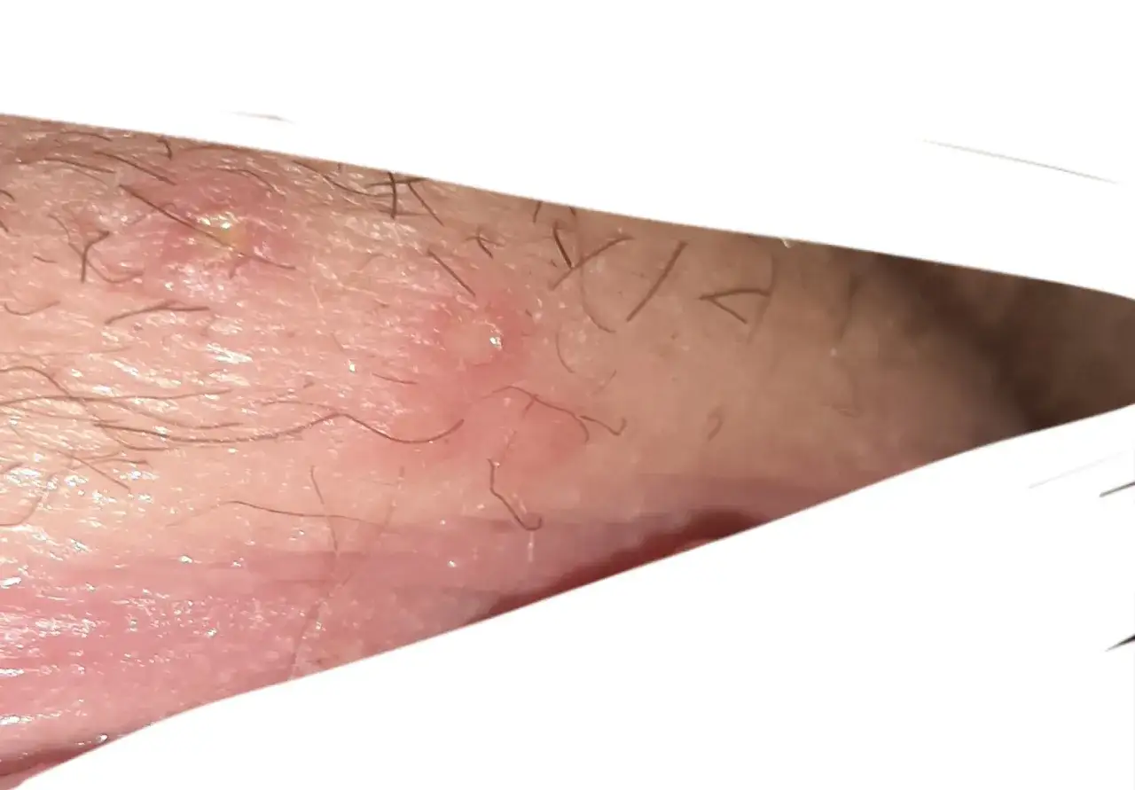 Zdjęcie Pryszcze w miejscach intymnych - przyczyny, objawy i skuteczne leczenie