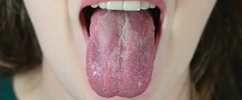 Zdjęcie Grzybica jamy ustnej u dzieci objawy - jak je rozpoznać i leczyć