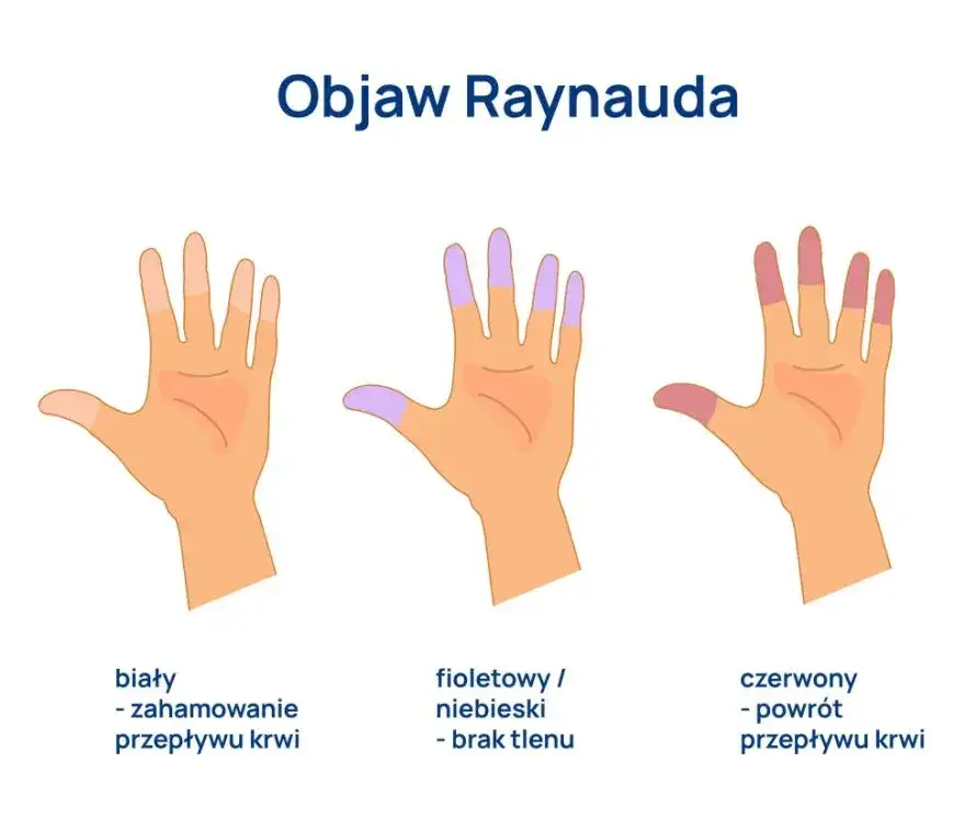 Zdjęcie Syndrom Raynauda: Jak rozpoznać objawy i co je wywołuje?