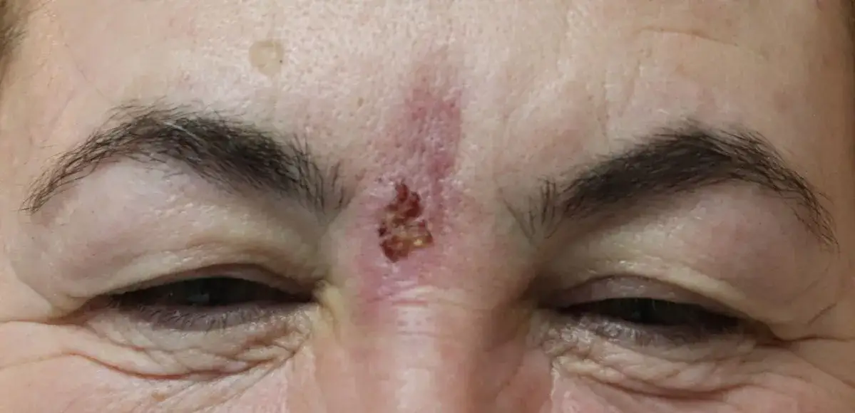 Zdjęcie Martwica po kwasie hialuronowym objawy - jak je rozpoznać i uniknąć?