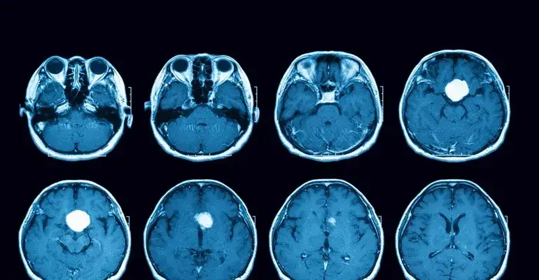 Zdjęcie Gruczolak przysadki: objawy psychiczne, które mogą zaskoczyć